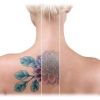Remoção de tatuagens: como funciona?